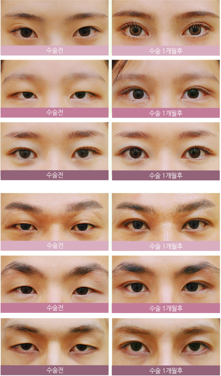 korean eyes before and after